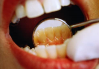  در مورد از بین بردن جرم  و زردی دندان